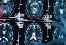 Нові фактори ризику деменції: холестерин і втрата зору