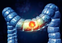 Несподіваний союзник у боротьбі з раком товстої кишки: як імунні клітини порушують правила