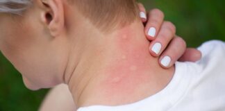 Why Mosquitoes Love You: The Real Science Behind Those Annoying Bites