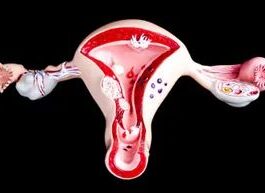L’adenomiosi influisce sulla fertilità?